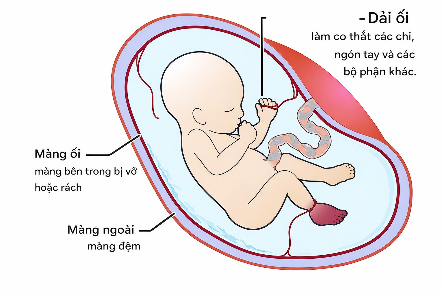 Ứng dụng can thiệp bào thai hiện đại trong điều trị hội chứng dải xơ buồng ối